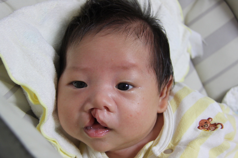 【写真】生後1ヶ月の頃のりょうくん。口唇裂の症状で上唇が分かれている