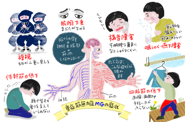 重症筋無力症の合併症