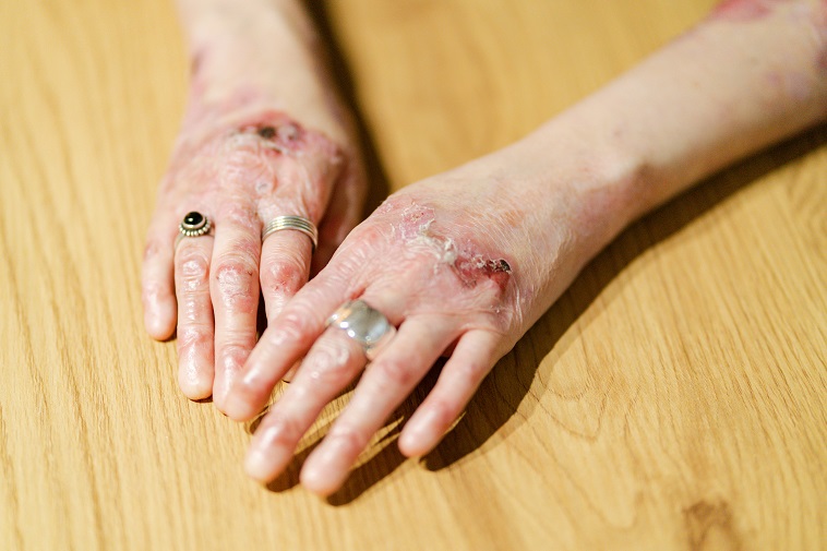 糖尿病性水疱の原因